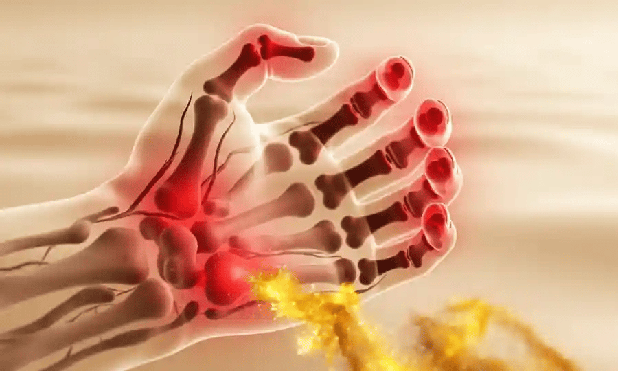 Animacion 3D: las articulaciones de una mano pasan del rojo inflamado al dorado y los dedos vuelven a cerrarse
